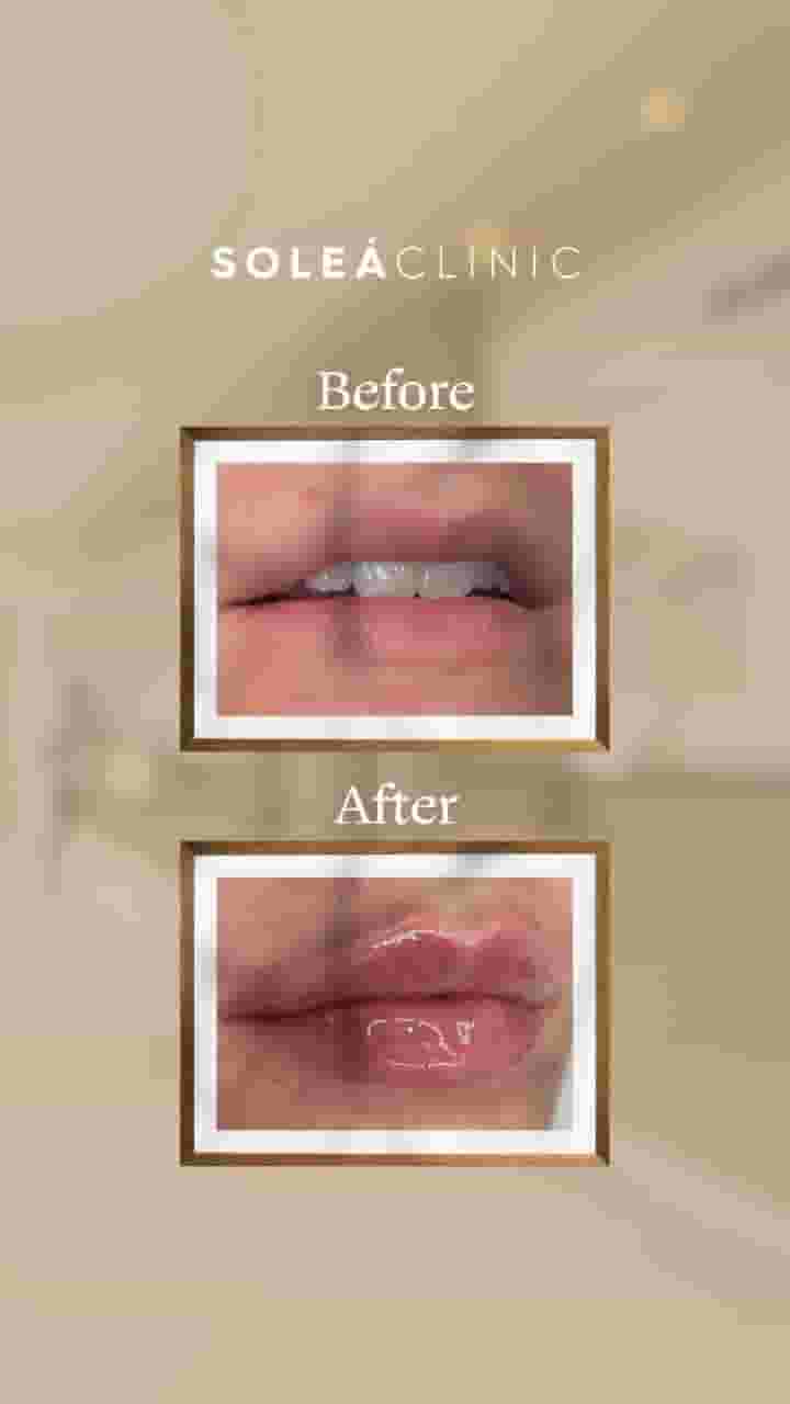 Botox lip filler